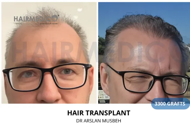 3000 Grafts Before and After 2025