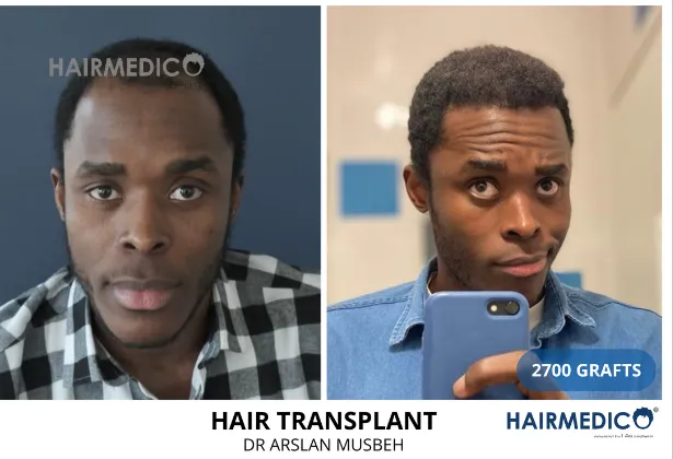 Afro hair transplant turkey