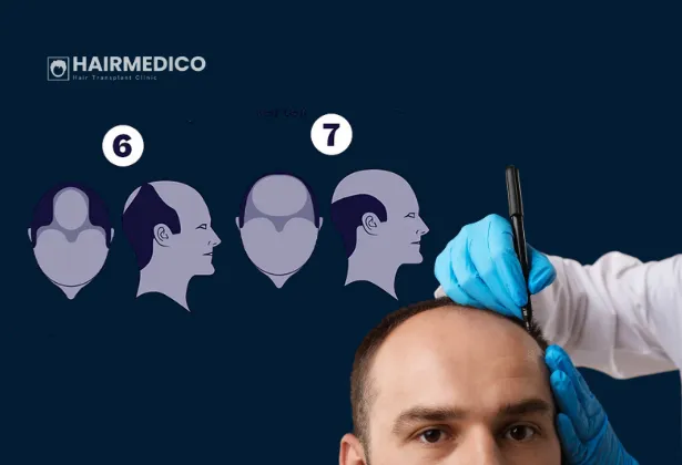 Norwood 6 veya 7 evresindeki hastalara saç ekimi yapılabilir mi?