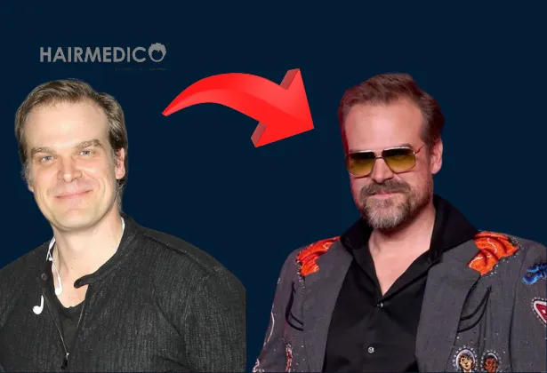David harbour hair transplant