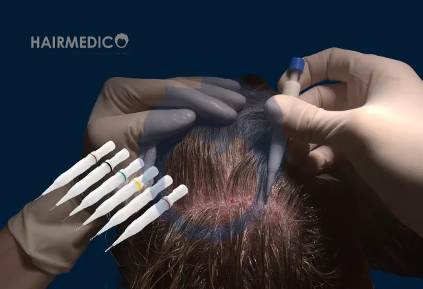 Méthode DHI Avis : Tout Savoir sur la Greffe de Cheveux DHI en Turquie