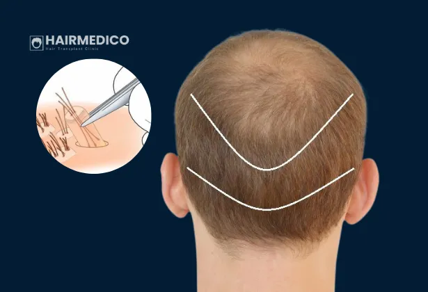 Bağış Alanı Tükenmesi: Yüksek Hacimli Kliniklerin Gizli Riski