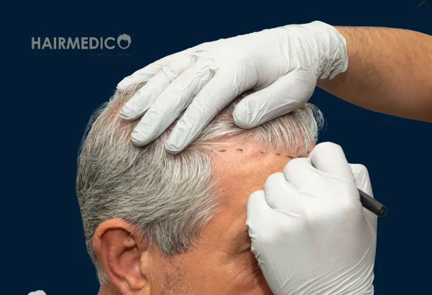 Hair Transplant from A to Z (2025): Step-by-Step Guide for Natural Results