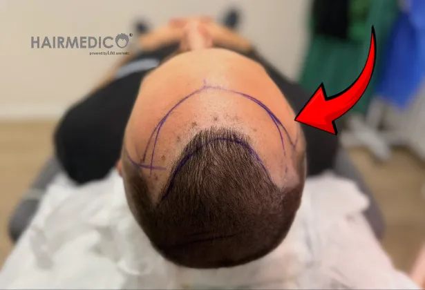 Saç Çizgisi Tasarımı Neden Doğal Sonuçları Belirler?