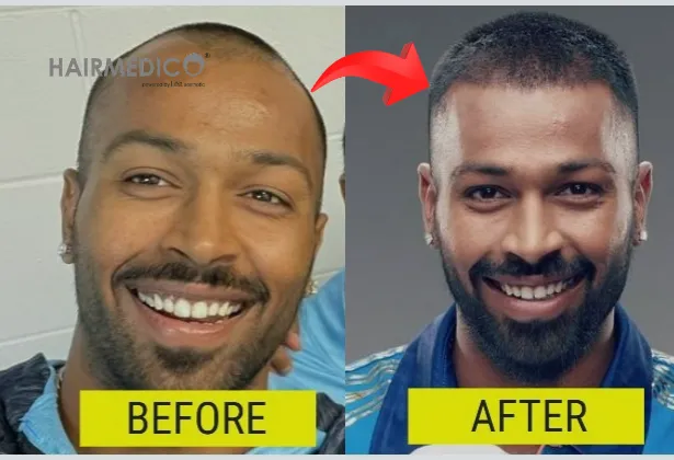 Krunal pandya hair transplant