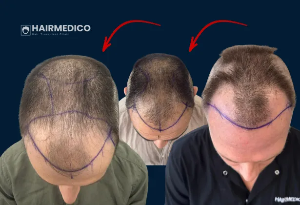 Saç Çizgisi Tasarımının Biyolojisi: Yalnızca Simetri Neden Bir Hatadır?