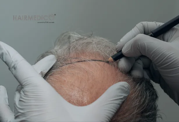 Türk Saç Ekimi Paketi