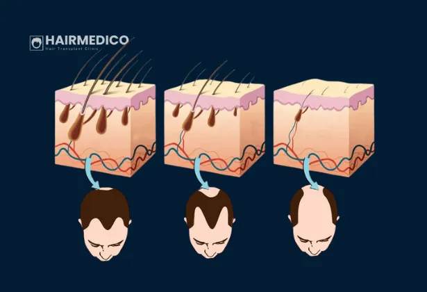 Modern Saç Ekimi Tekniklerinde Foliküler Yaşam Oranlarını Anlamak