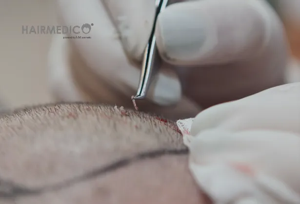 Saç Ekiminde Greft Kalitesi Nedir?