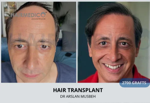 Günümüzde Saç Ekimi Neden Doğal Görünüyor? – Modern FUE, DHI