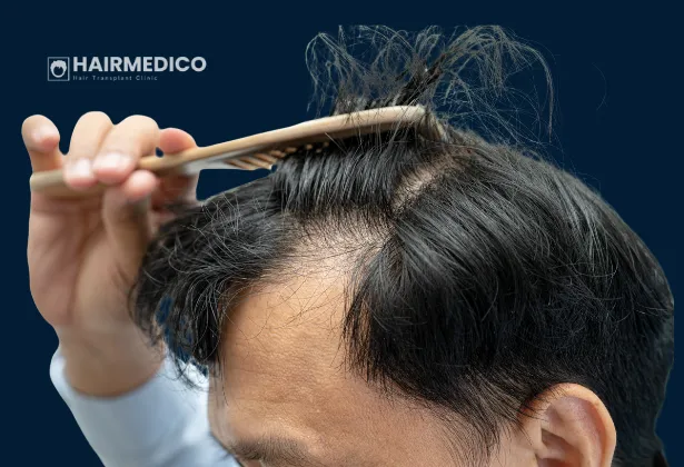 Why Some Hair Transplants Fail Despite High Graft Numbers