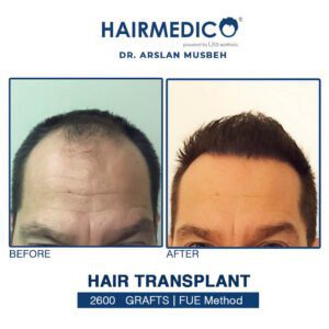 Hair Transplant Turkey Reviews
