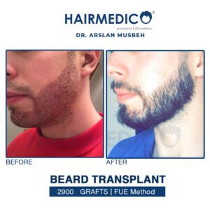 Beard Transplant Turkey