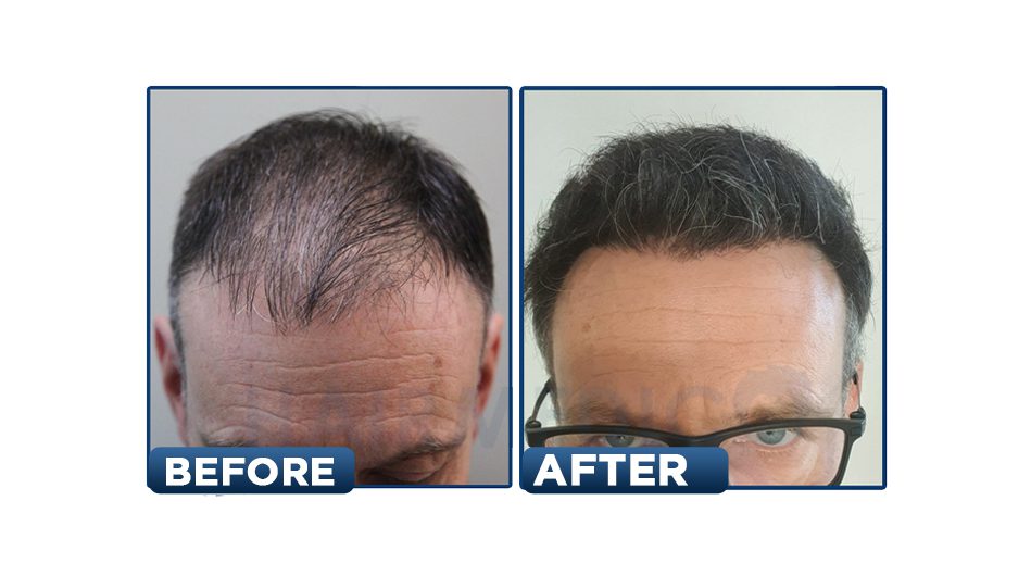 10 Best Clinics for Hair Implant in Turkey [2022 Prices]