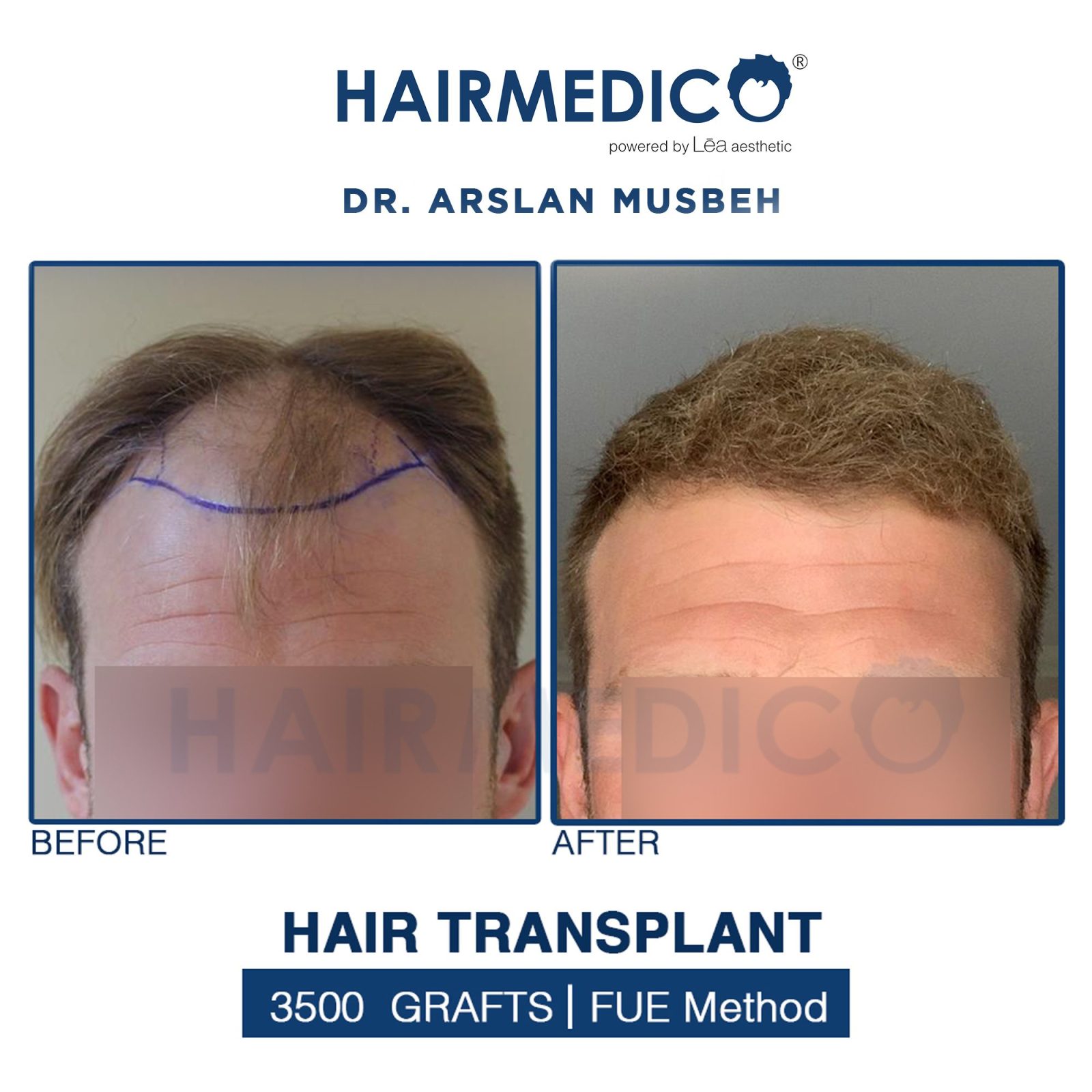 Hair Transplant Results | Amazing photos 2023 – HAIRMEDICO | Dr ARSLAN