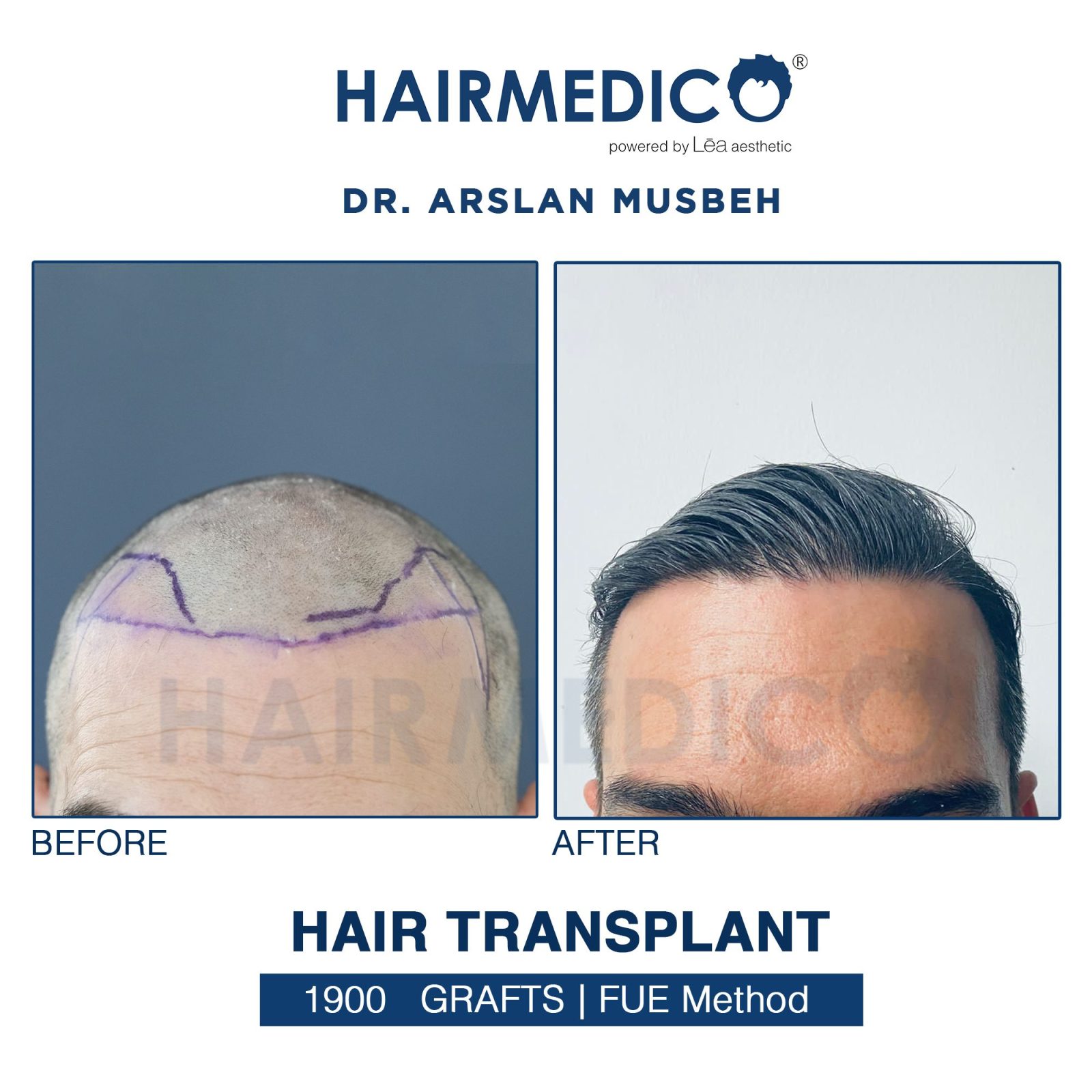Hair Transplant in Turkey