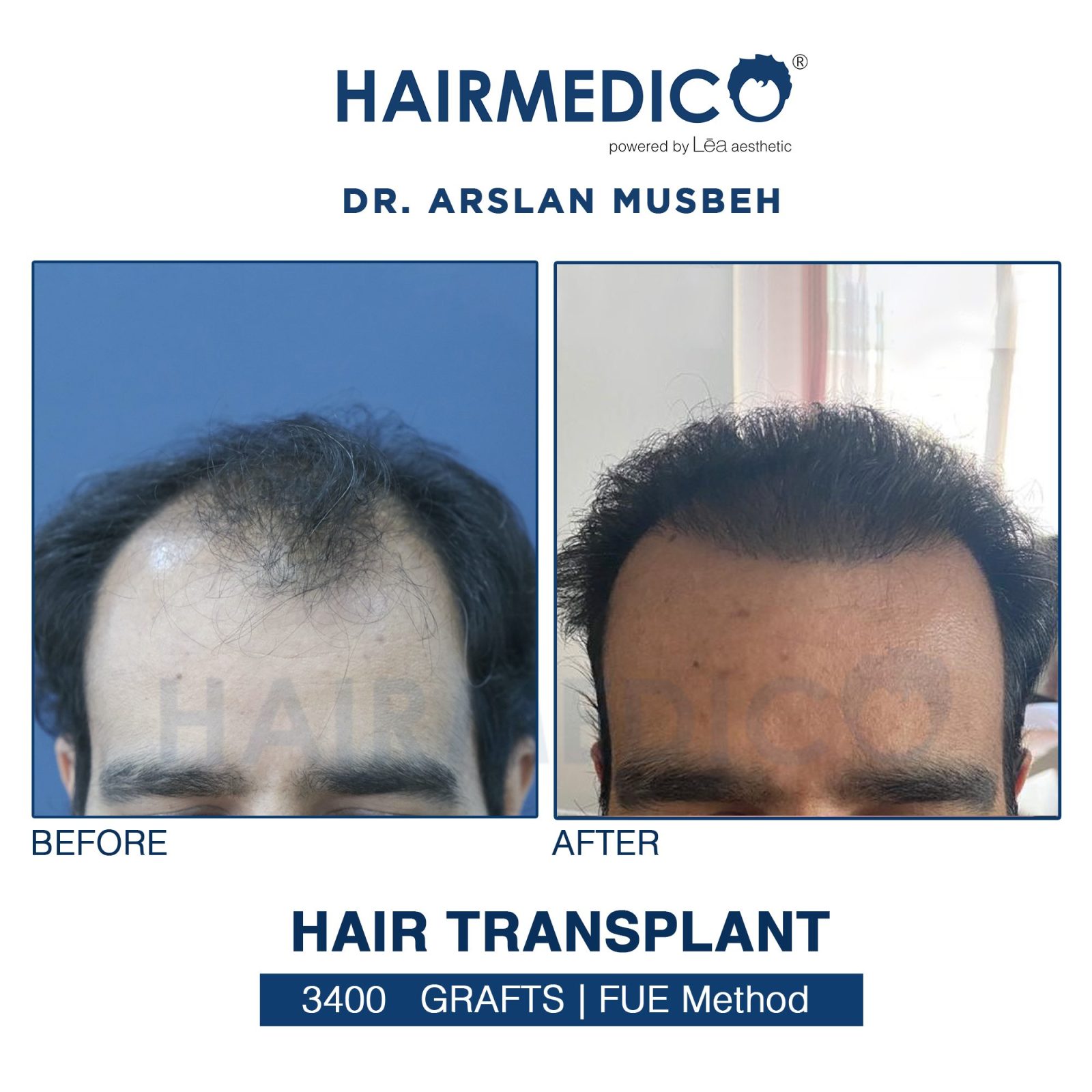 Hair Transplant in Turkey. Dr Arslan Musbeh