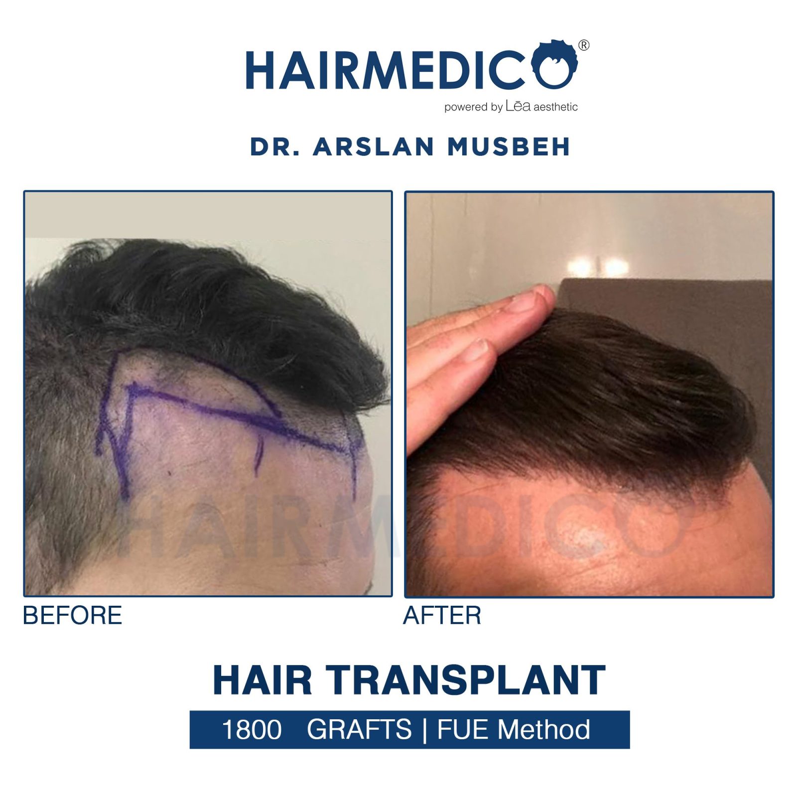 Hair Transplant Results | Amazing photos 2023 – HAIRMEDICO | Dr ARSLAN