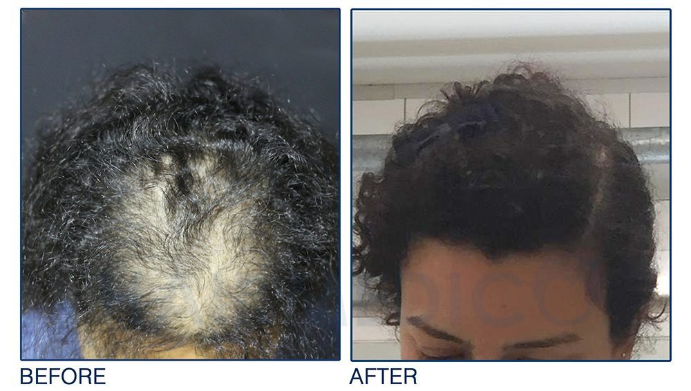 woman hair transplant loss