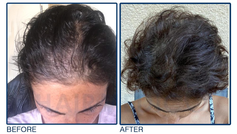 Afro women hair transplant,before and after hair transplant