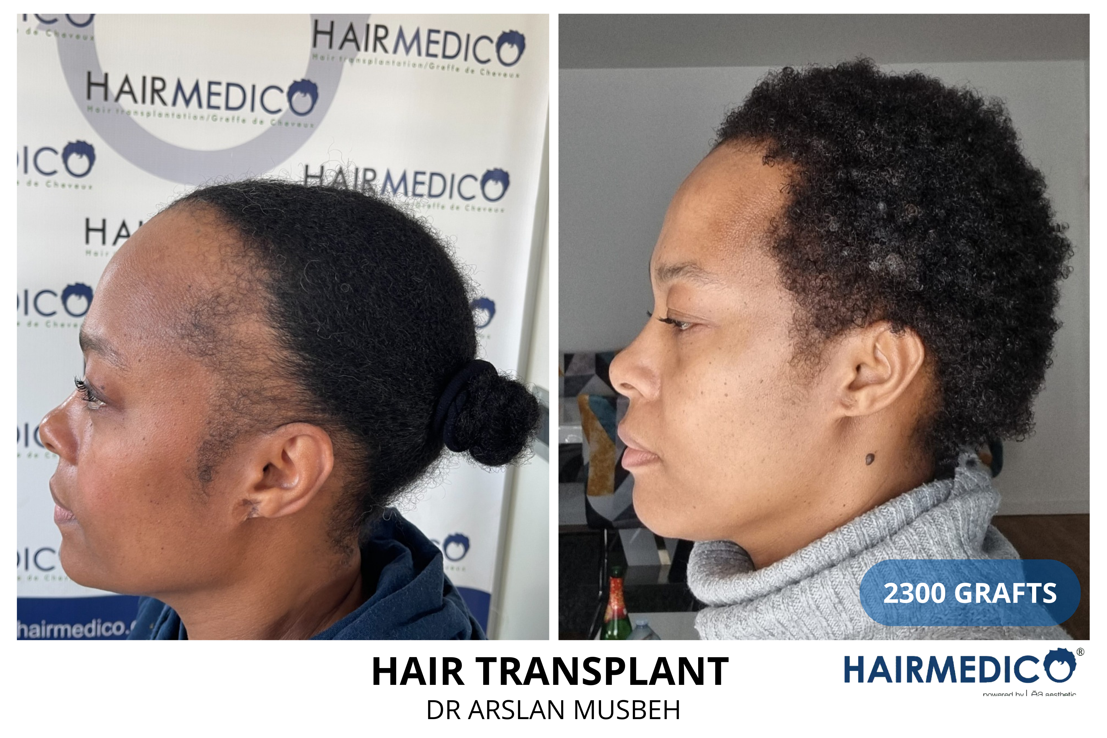 Afro hair transplant,before and after hair transplant