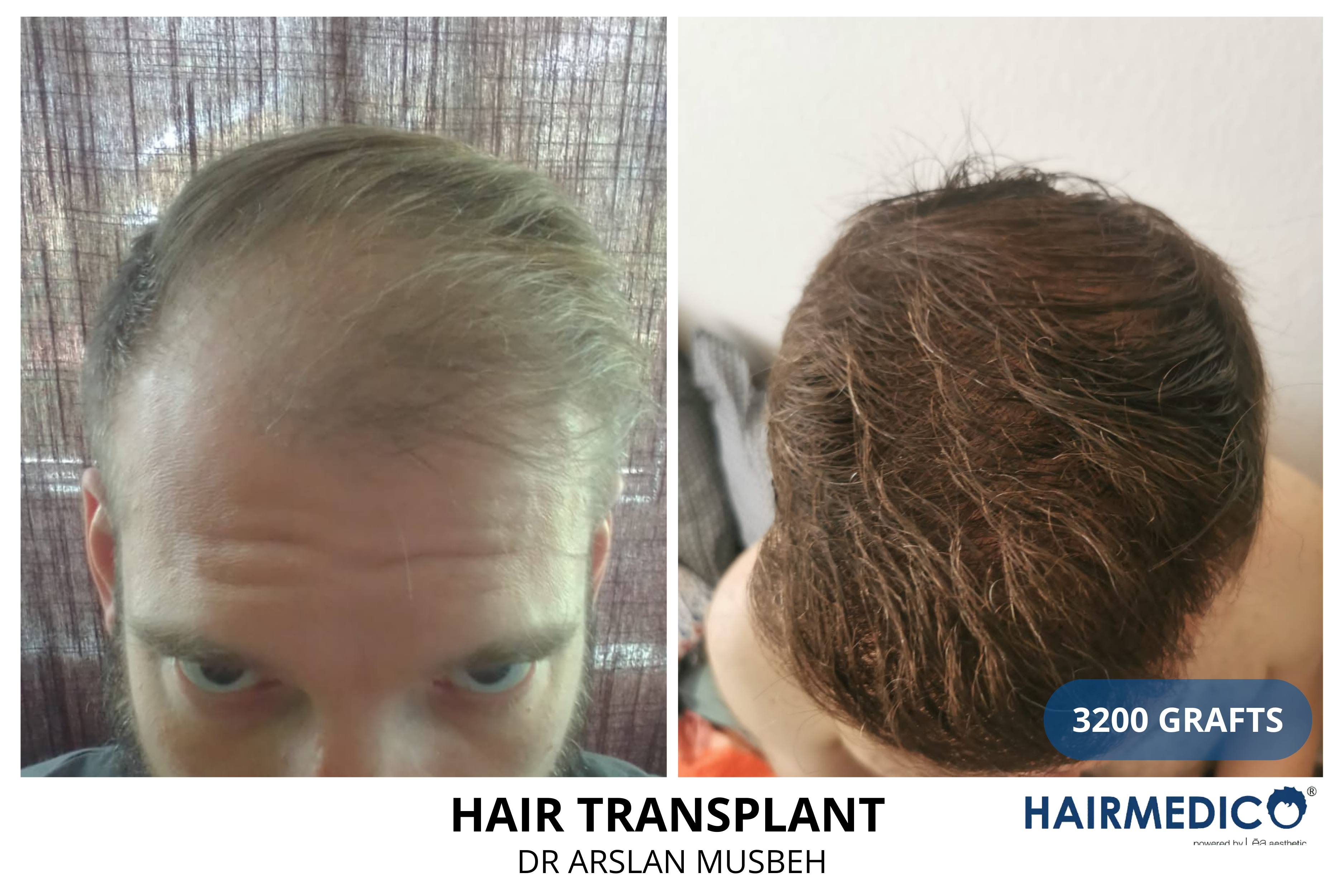 Afro women  hair transplant,before and after hair transplant