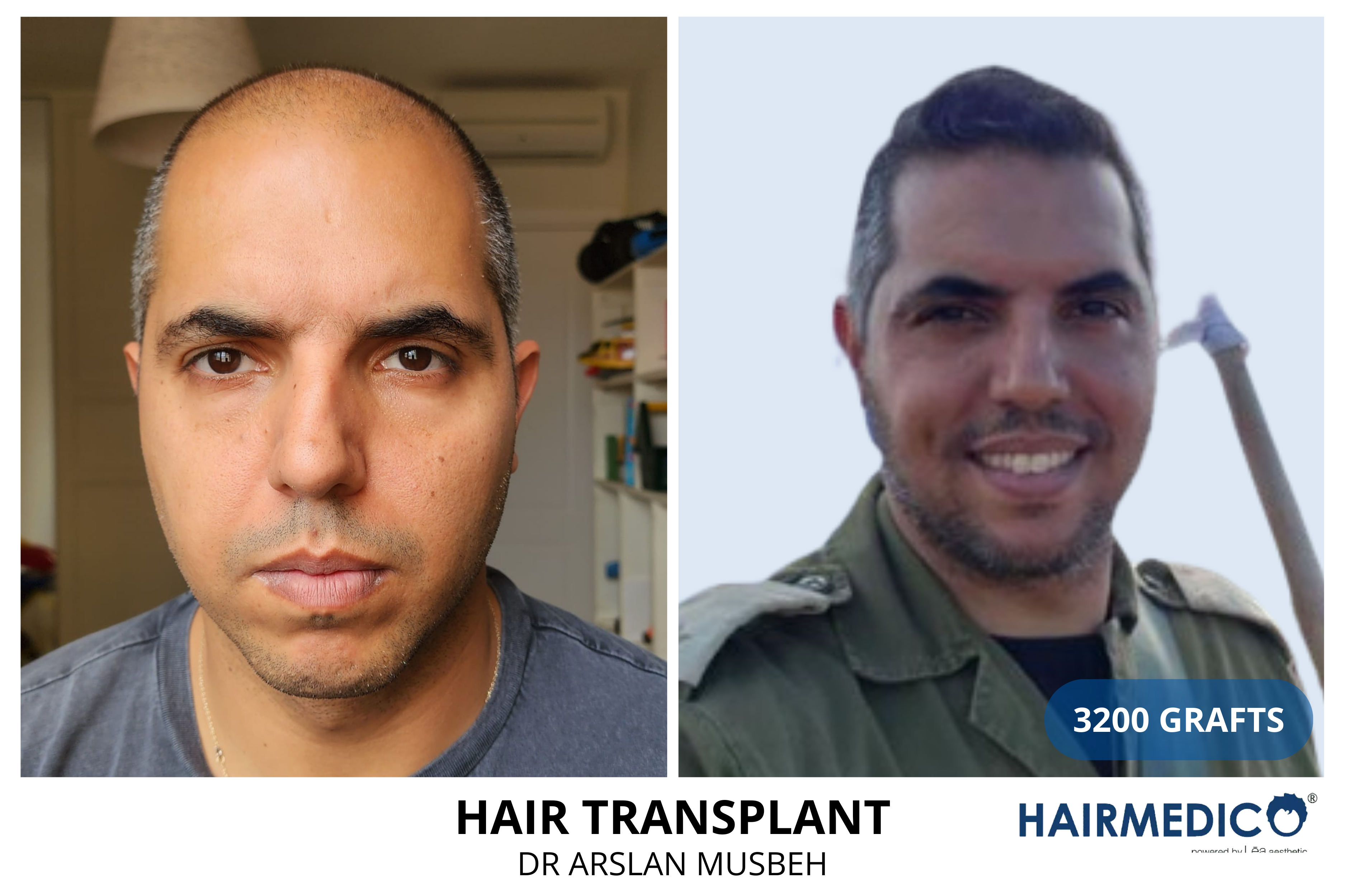 Afro women  hair transplant,before and after hair transplant