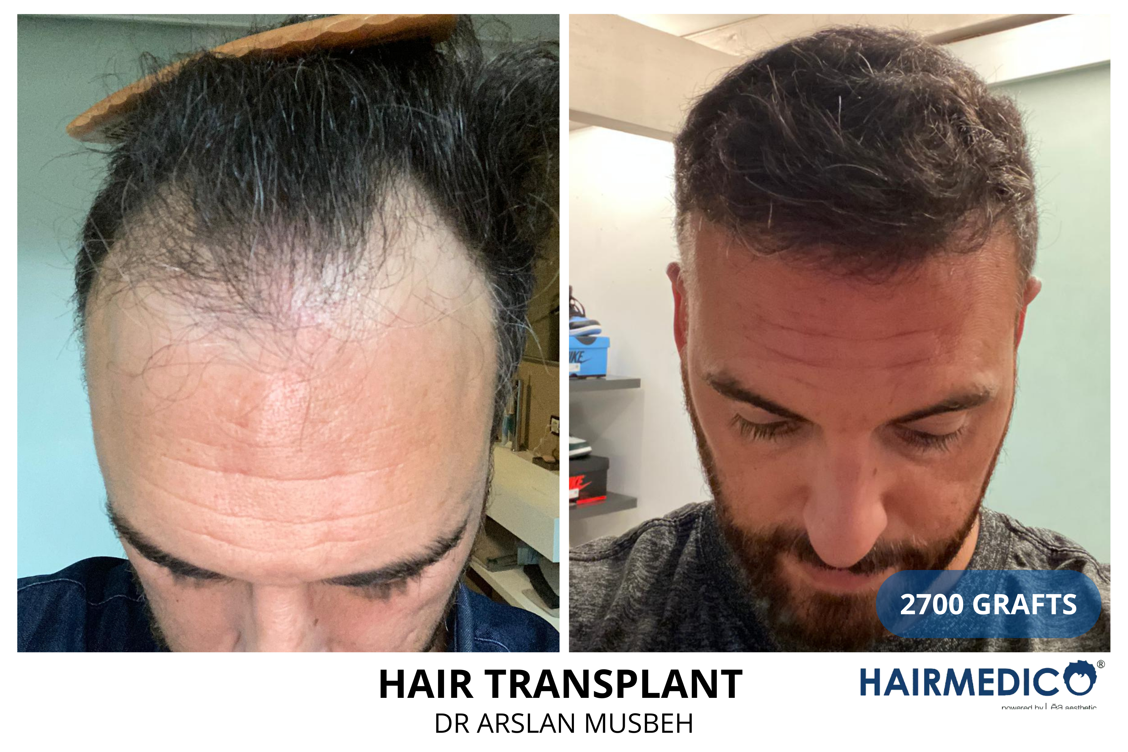 Afro hair transplant,before and after hair transplant