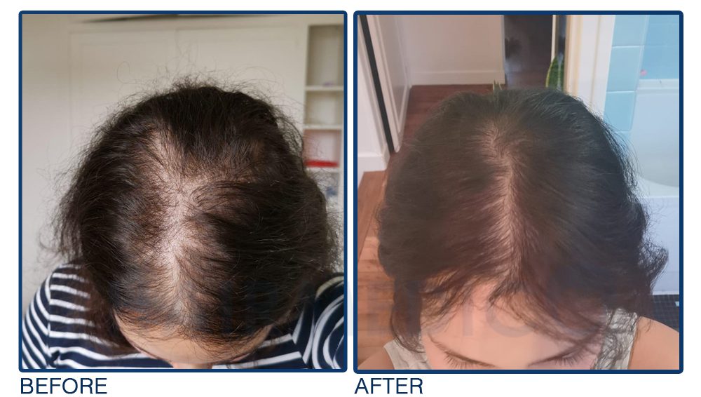 Afro women hair transplant,before and after hair transplant
